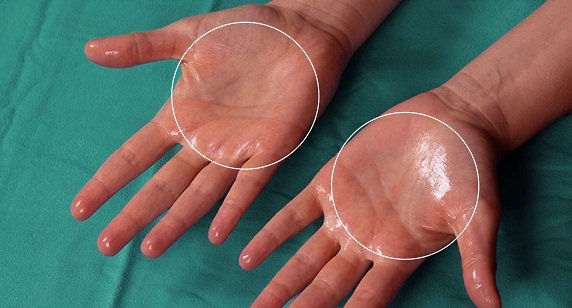 Hyperhidrosis