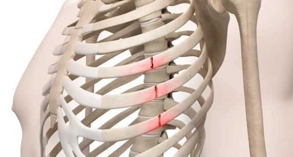 RIB Fractures