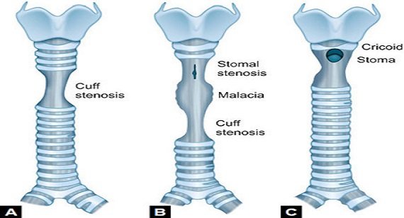 Tracheal Stenosis